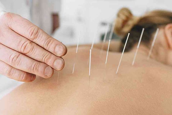 acupuncture